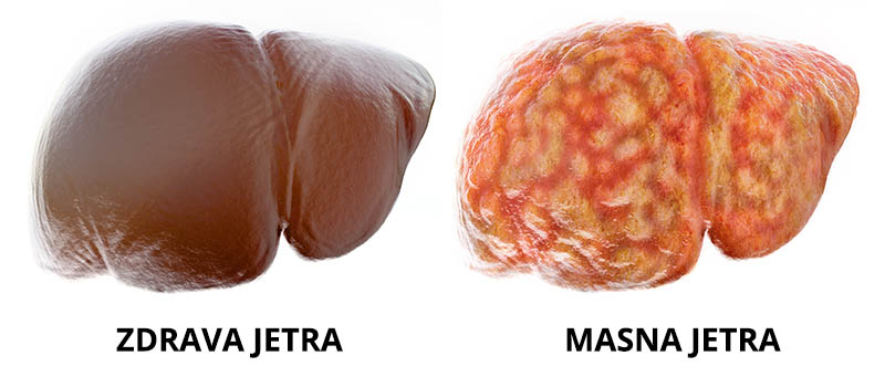 zdrava - masna jetra