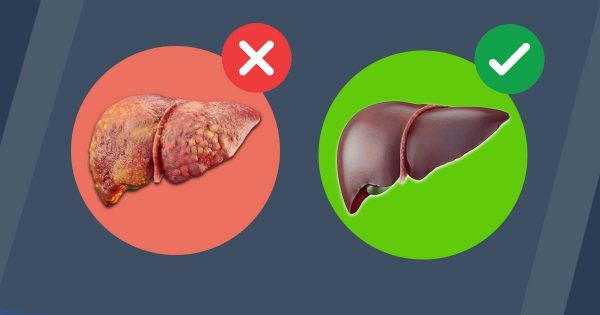 Čišćenje jetre – ovako nestaje masnoća s trbuha
