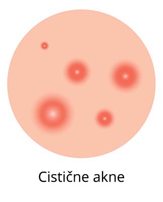 cistične akne